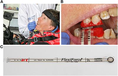 The Maximum Bite Force for Treatment Evaluation in Severely Affected Adult SMA Patients—Protocol for a Longitudinal Study